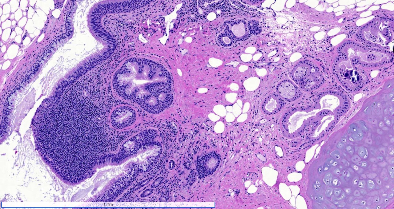 Lipoma and Teratoma