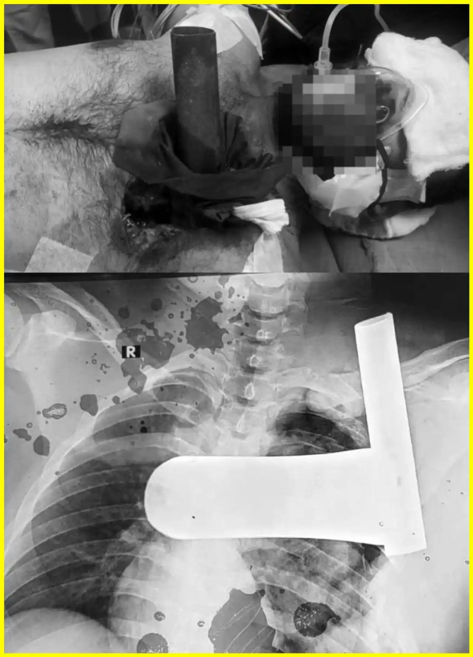 RNT Medical College : 9-Inch Iron Pipe Pierces Chest, Doctors Save Life