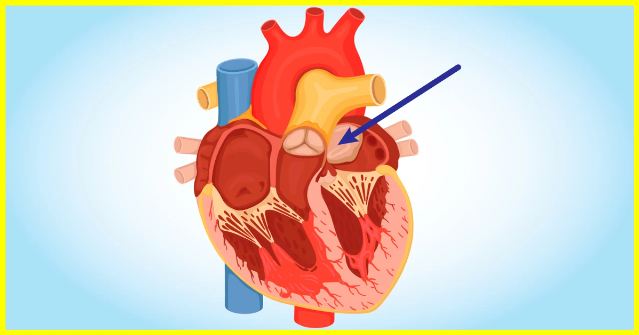 Heart Tumour