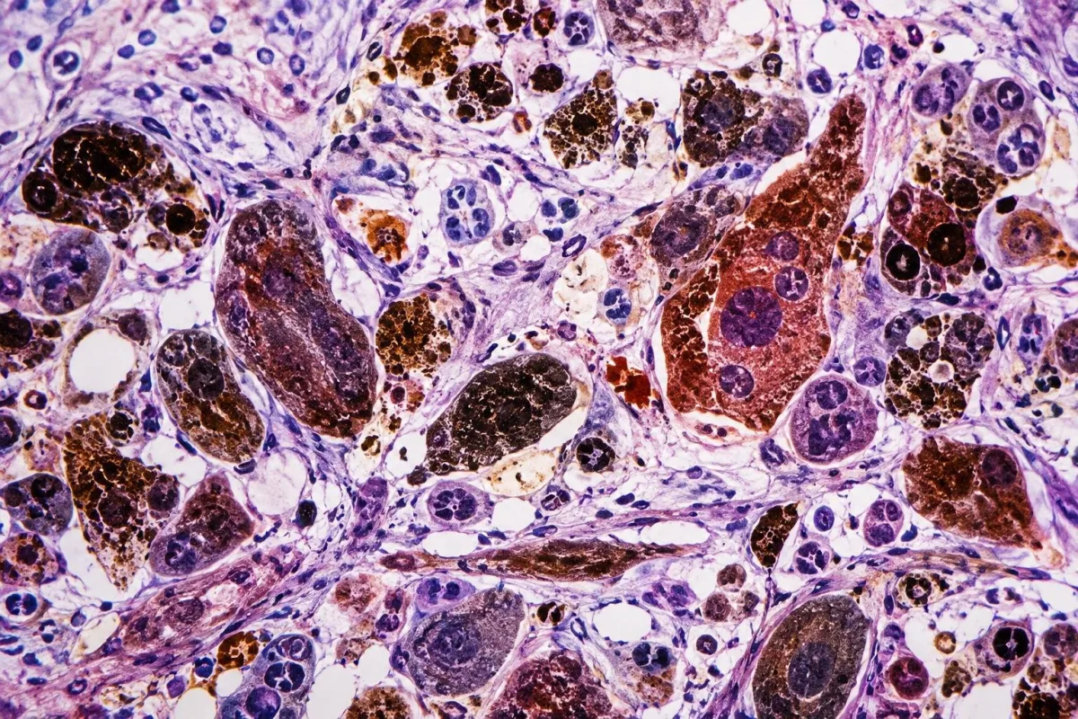 93-Year-Old Woman Misdiagnosed with Nipple Melanoma